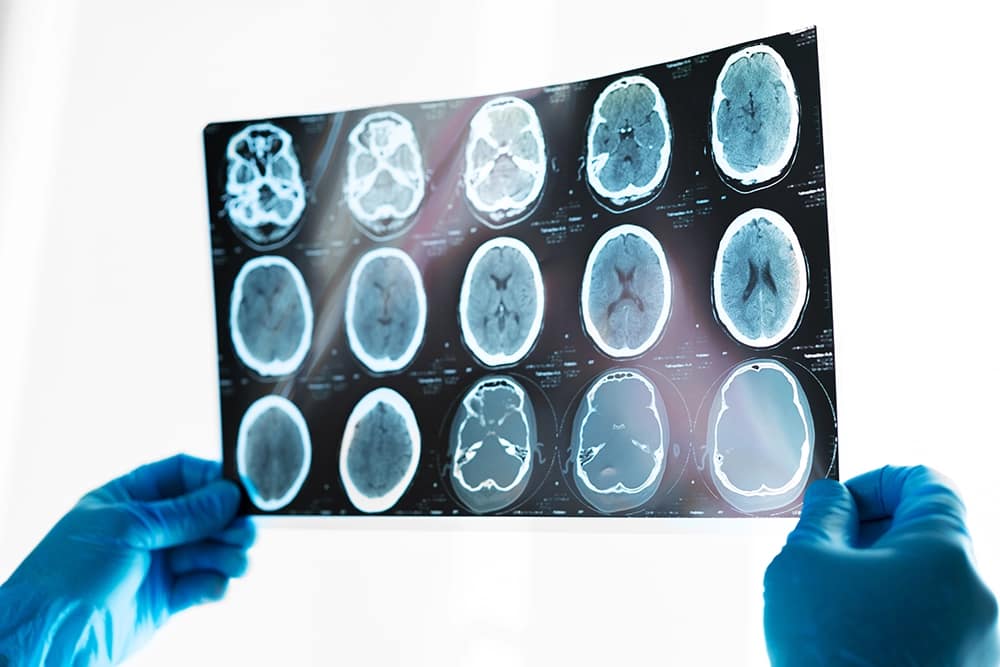brain injury Brain scan being held up by doctor.